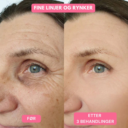 Lunaria Mikronål Infusjonsbehandling