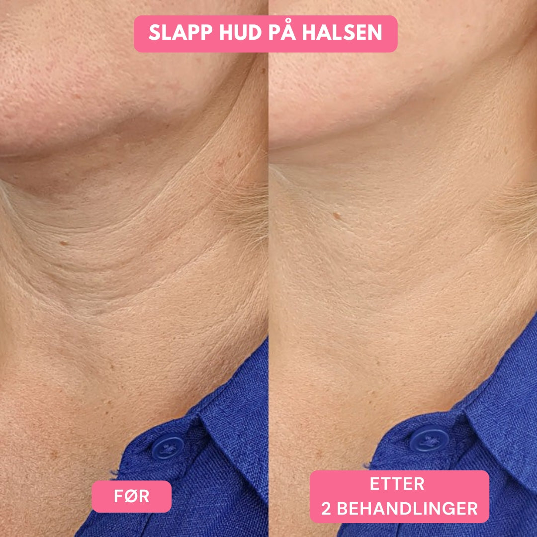 Lunaria Mikronål Infusjonsbehandling