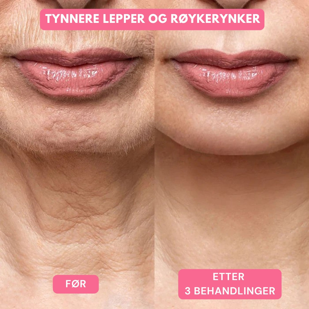 Lunaria Micro-Infusion Behandling